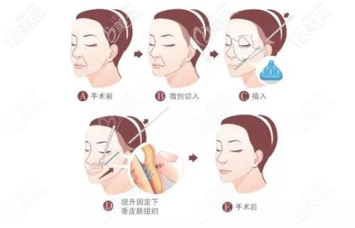 面部埋线的部位 面部埋线的部位