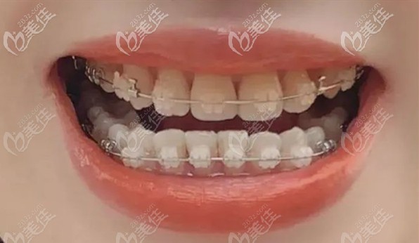 骨性龅牙在<!--<i data=20240703-sp></i>-->齿科矫正过程图 骨性龅牙在<!--<i data=20240703-sp></i>-->齿科矫正过程图