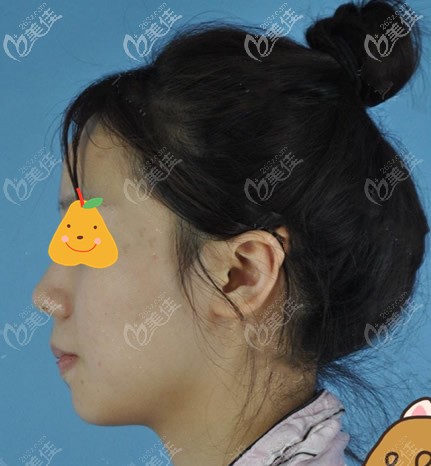 兰州梦想整形医院脸部抽脂前 兰州梦想整形医院脸部抽脂前