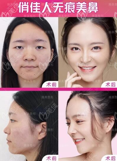 雅美俏佳人无痕美鼻真人案例 雅美俏佳人无痕美鼻真人案例