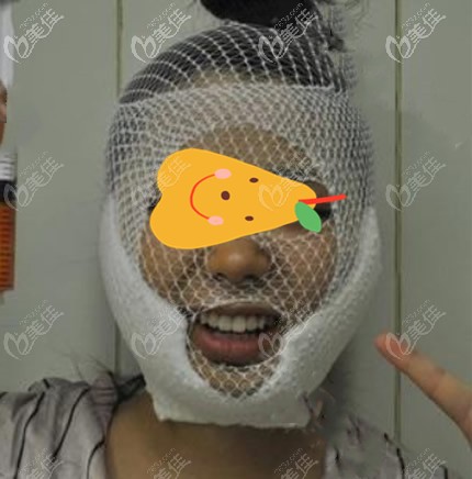 兰州梦想赵梅霞给我做面部吸脂第二天 兰州梦想赵梅霞给我做面部吸脂第二天