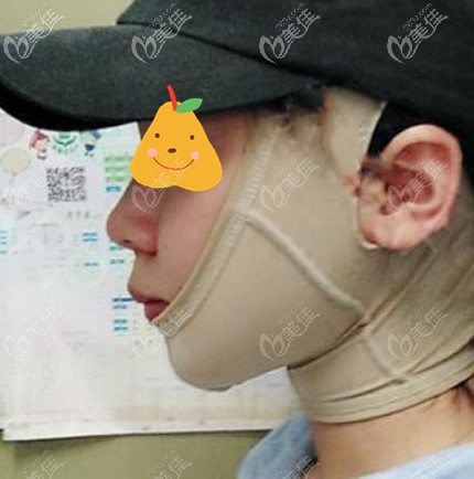 面部吸脂后带头套能预防凹凸不平 面部吸脂后带头套能预防凹凸不平