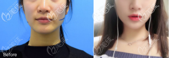 下颌角切除一个月的术前术后对比照片 下颌角切除一个月的术前术后对比照片