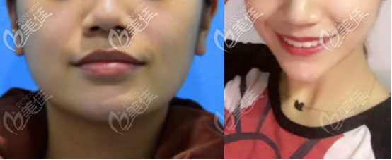 下颌角切除一个月的术前术后对比照片 下颌角切除一个月的术前术后对比照片