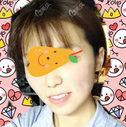 脸部抽脂7天<span style= 脸部抽脂7天<span style=