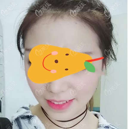 面部吸脂做完10天图片 面部吸脂做完10天图片