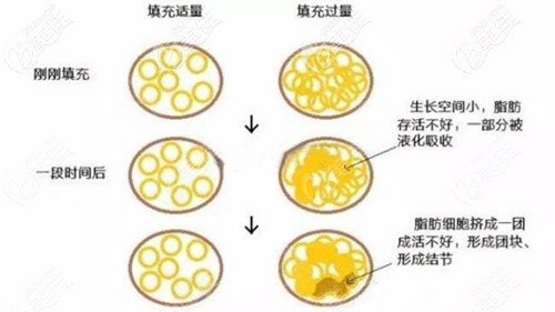 在术后脂肪填充过量会导致液化结节
