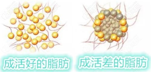 成活好的脂肪和成活差的脂肪对比