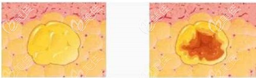 为啥脂肪填充后会出现液化