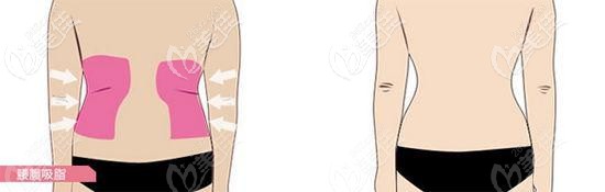 腰腹吸脂手术 腰腹吸脂手术