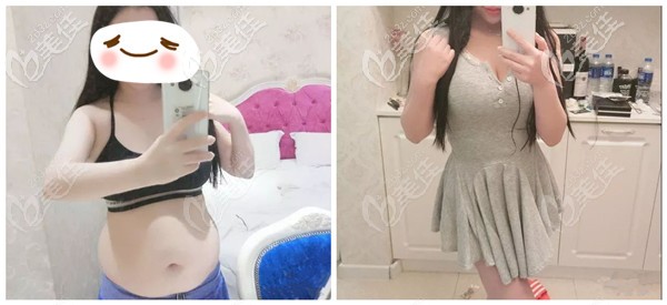 做腰腹吸脂术后1个月效果明显 做腰腹吸脂术后1个月效果明显