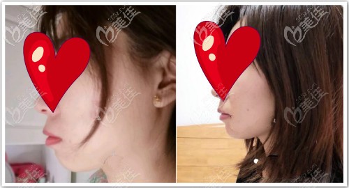 我骨性反颌做正畸+正颌手术恢复半年效果图片 我骨性反颌做正畸+正颌手术恢复半年效果图片