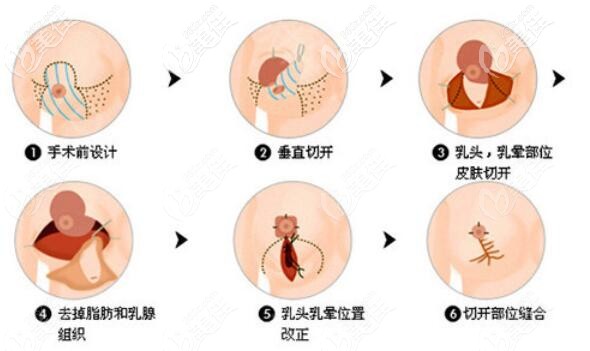 垂直双蒂切开法缩胸介绍 垂直双蒂切开法缩胸介绍