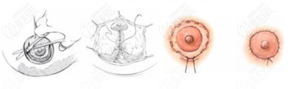 乳晕真皮帽双环法缩胸原理和价格介绍 乳晕真皮帽双环法缩胸原理和价格介绍