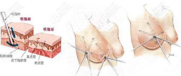 立体环吸吸脂法缩胸原理和价格介绍 立体环吸吸脂法缩胸原理和价格介绍