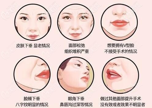面部埋线提升适合人群 面部埋线提升适合人群
