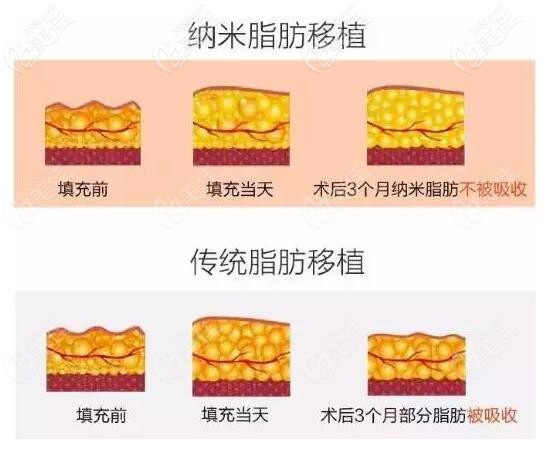 纳米脂肪和传统脂肪效果的对比 纳米脂肪和传统脂肪效果的对比