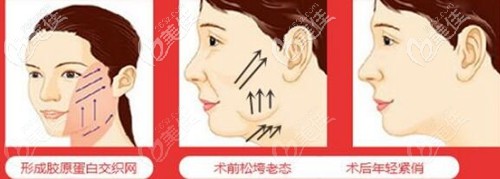面部埋线提升的效果 面部埋线提升的效果