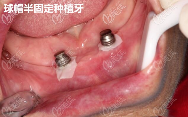 球帽半固定种植牙