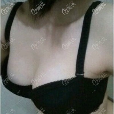 武汉卓美吴秀英隆胸案例:做法国ES伊思雅假体隆胸恢复十天效果
