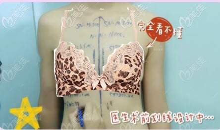 卓美吴秀英医生给我胸部术前设计划线