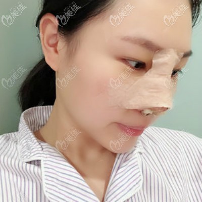 在武汉亚韩找邓正辉医生做自体肋骨隆鼻术后第3天