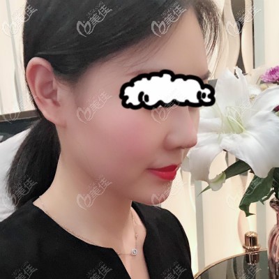 花3万在亚韩做自体骨隆鼻10天<span style=