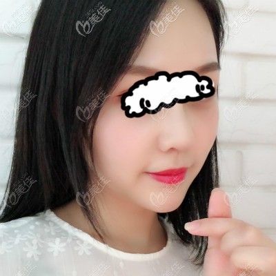 武汉亚韩邓正辉医生为我做自体肋骨隆鼻45天<span style=