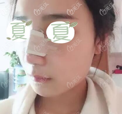 鼻综合术后第3天