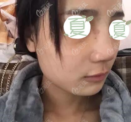 鼻综合术后第8天拆线