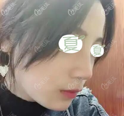 做鼻综合术后16天恢复效果