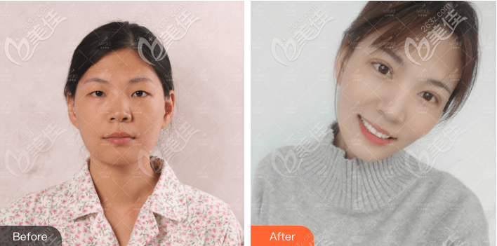 北京全切双眼皮多少钱?花3万多找北京美莱王鹤做的全切双眼皮案例效果展示 北京全切双眼皮多少钱?花3万多找北京美莱王鹤做的全切双眼皮案例效果展示