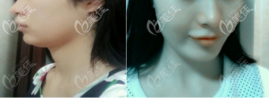 自体脂肪填充下巴一个月后的效果图