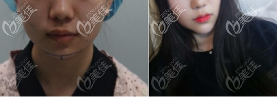 自体脂肪填充下巴一个月后的术前术后对比效果图