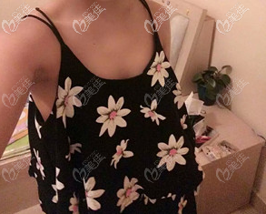 <!--<i data=20240703-sp></i>-->自体脂肪丰胸术前照片 <!--<i data=20240703-sp></i>-->自体脂肪丰胸术前照片