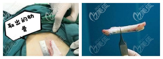 鼻综合用的半肋骨和全肋骨