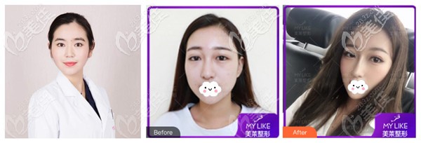 齐一帆医生做肋软骨隆鼻前后对比