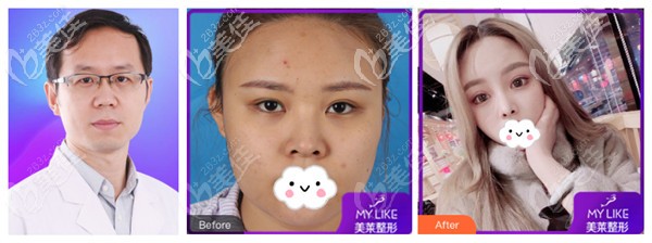 于双全医生做肋软骨隆鼻案例