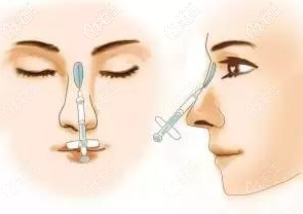 注射隆鼻示意图 注射隆鼻示意图