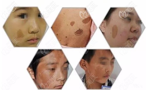 各种咖啡斑