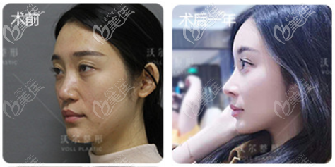 北京隆鼻手术多少钱一次?我花7万多找北京沃尔刘彦军隆鼻案例效果参考 北京隆鼻手术多少钱一次?我花7万多找北京沃尔刘彦军隆鼻案例效果参考