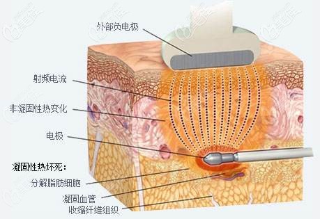 射频溶脂瘦脸原理