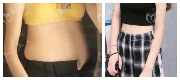 <!--<i data=20240703-sp></li>
                        </a>
                       </ul>
                    </div>
                                        <p>无论有过生育还是没有生过宝宝的女人,都会有一个烦恼,那就怎么减也不见有变瘦效果的腰腹部,并且还特别容易堆积脂肪,一般堆积的脂肪在腰腹部各个小部位的厚度也不一样,所以就有了</p>
                        <div class=