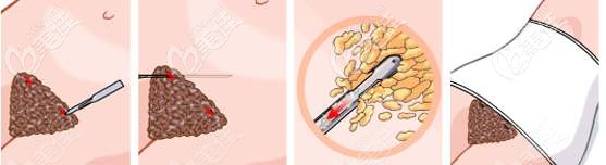 腰腹吸脂手术过程 腰腹吸脂手术过程