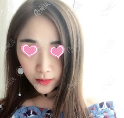 注射玻尿酸丰下巴术后一周效果