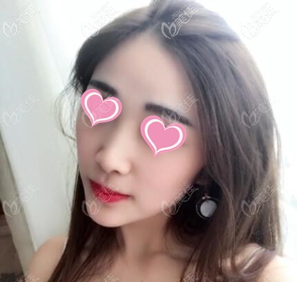 玻尿酸垫下巴半个月效果照