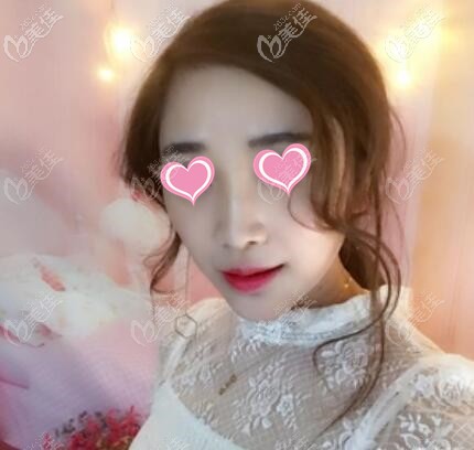 伊婉玻尿酸垫下巴术后1个月效果照