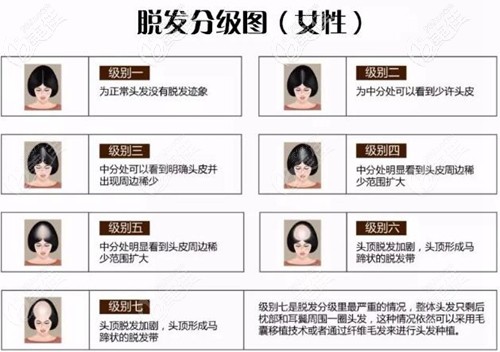 女士脱发等级分级图 女士脱发等级分级图