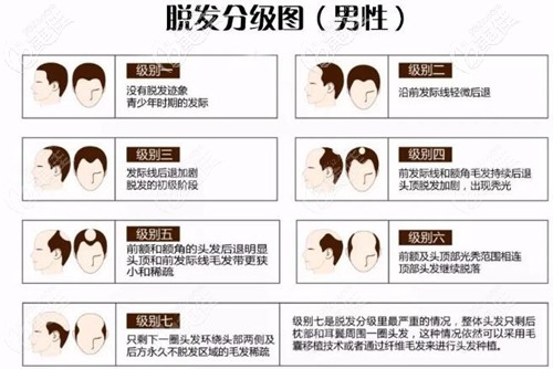 男士脱发等级分级图 男士脱发等级分级图