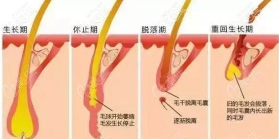 毛发移植手术后的脱落期 毛发移植手术后的脱落期
